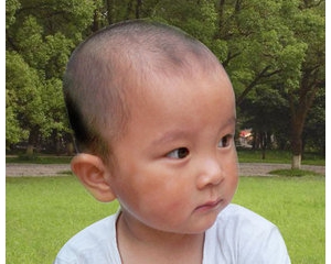 婴幼儿也会得白癜风？是因为遗传吗？