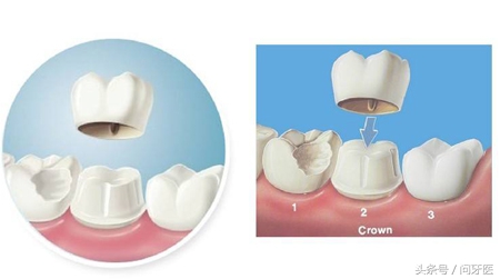 杀牙神经后不治疗了可以吗,杀牙神经不补牙可以吗