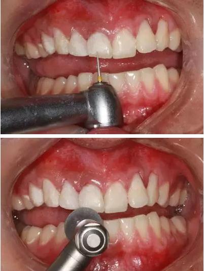 可乐牙治疗实拍,可乐牙治疗好前后图片