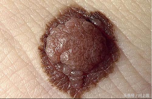 图解成年人常见的皮肤问题