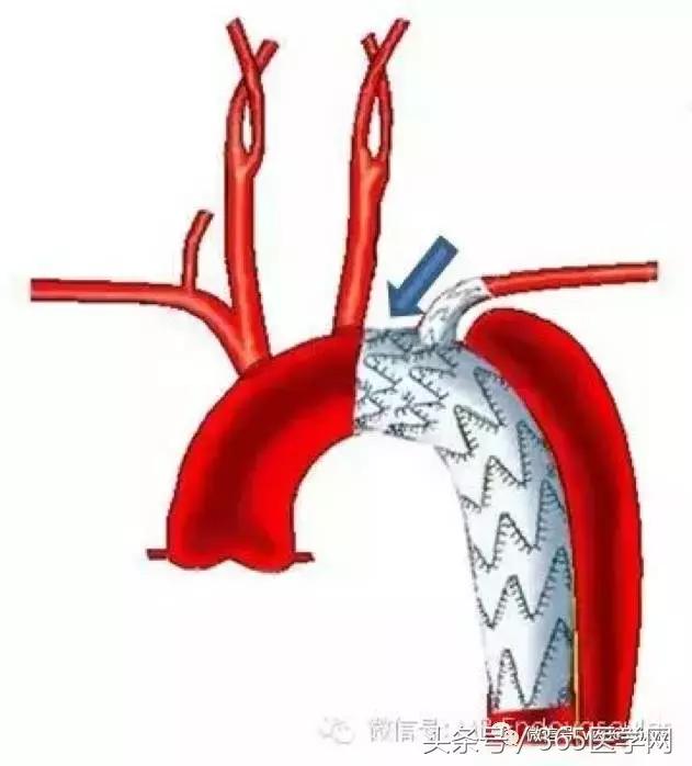 胸主动脉瘤保守治疗的方法,江西省胸科医院黄建华