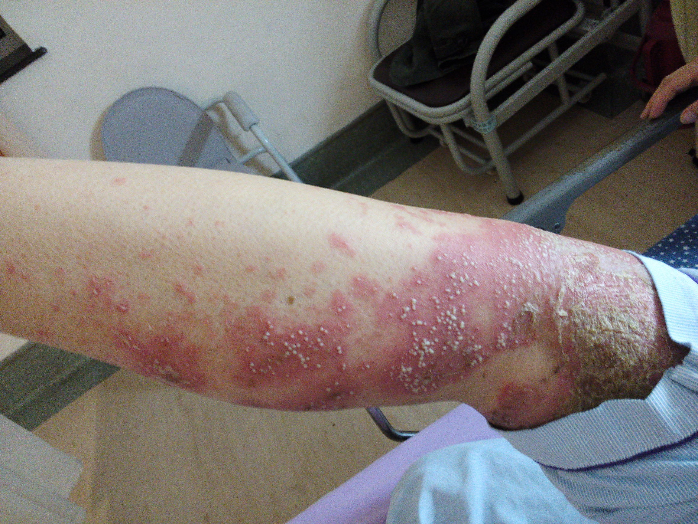 福州皮肤科看银屑病吗,武汉协和皮肤科银屑病