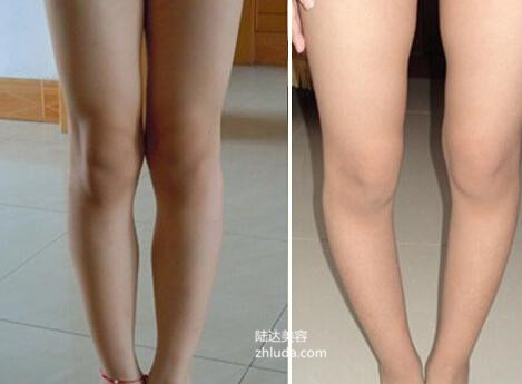 大腿和小腿不在一条线怎么矫正,腿型不好看怎么矫正直腿