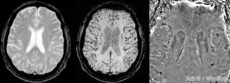 脑出血和脑溢血有何区别,脑出血与脑溢血是什么原因引起的