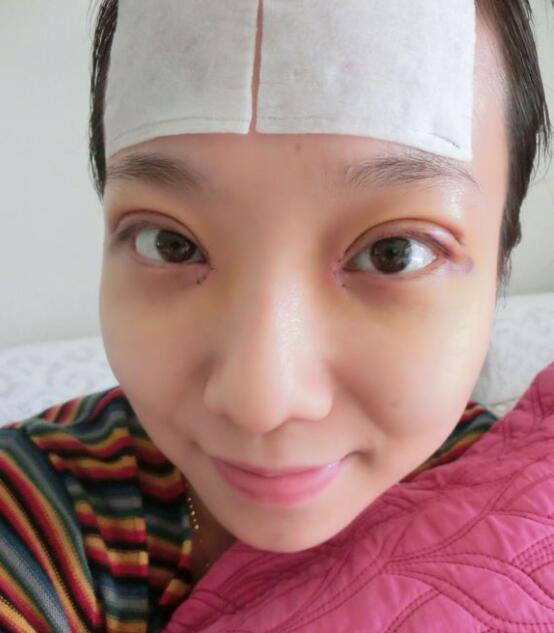 完美的埋线双眼皮,完美双眼皮