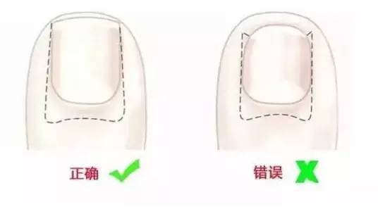 喜欢美甲的女孩要注意一种疾病：嵌甲