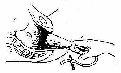 顺产时医生助产,顺产技巧及如何配合助产士