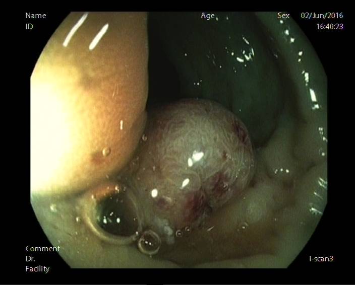 普通内镜与Pitpattern分型（多图详解）