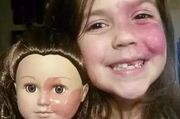 女儿有红胎记，妈妈是这样做的！