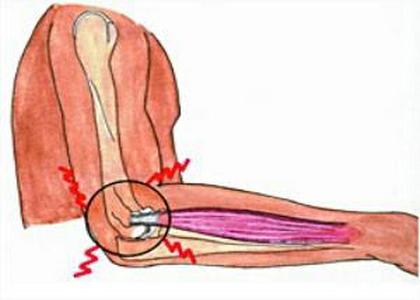灸哥论穴:用艾灸疗法调理网球肘