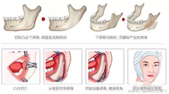 瘦脸针能瘦脸这种说法正确吗,瘦脸针真的能起到瘦脸的效果吗