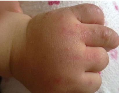 宝宝对牛奶过敏怎么改善体质,怎么改善易过敏体质