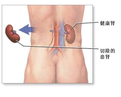 慢性肾衰健康指导,肾切除术后康复指导