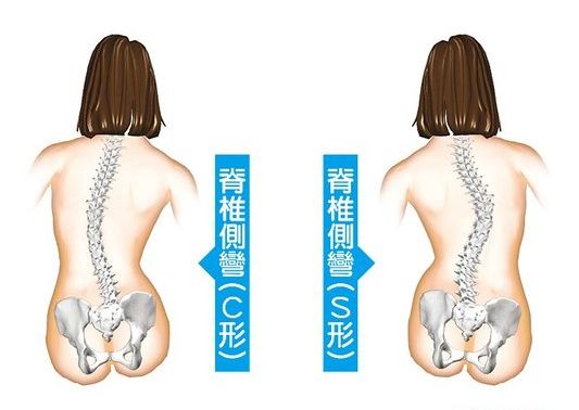 小儿脊柱侧弯治疗的正确方法,脊柱侧弯治疗大概需要多少钱