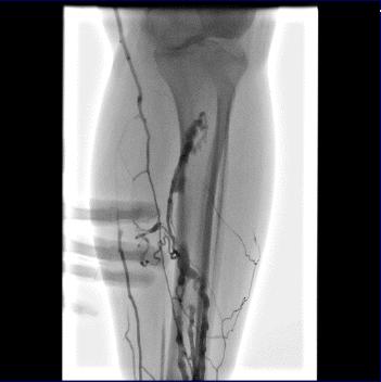 下肢肿胀有效的治疗手段是什么？