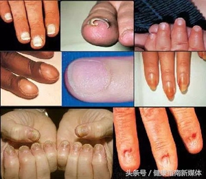 宝宝会得灰指甲什么样子,宝宝指甲像灰指甲怎么办