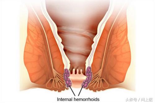 肛肠疾病你到底了解多少,痔疮知识自测