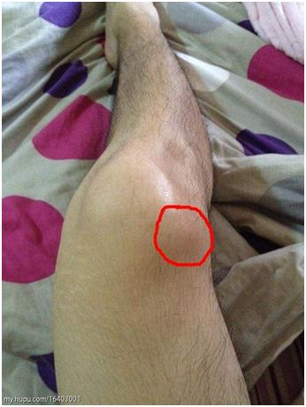 皮肤出现瘀斑是肝癌吗,皮肤出现小黑点是什么癌症