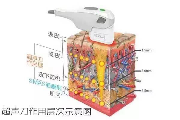 超声刀美容危害，正版超声刀与山寨超声刀的区别