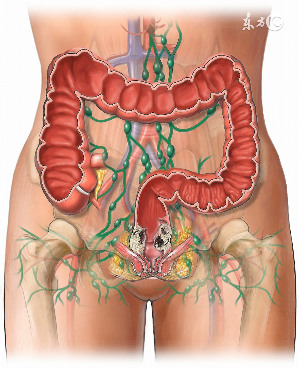 2b期宫颈癌局部晚期的症状,宫颈癌1b3期是局部晚期吗
