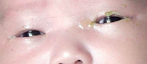 宝宝眼屎黄多是不是上火了,宝宝眼屎多且黄还粘稠怎么回事