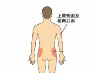 臀腰寒凉怎么治,臀腿凉怎么办