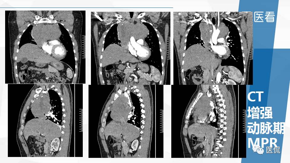 精原细胞瘤ct影像,精原细胞瘤影像特征