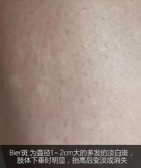 不是白癜风的白斑能查出是什么吗,不是白癜风的白点是啥