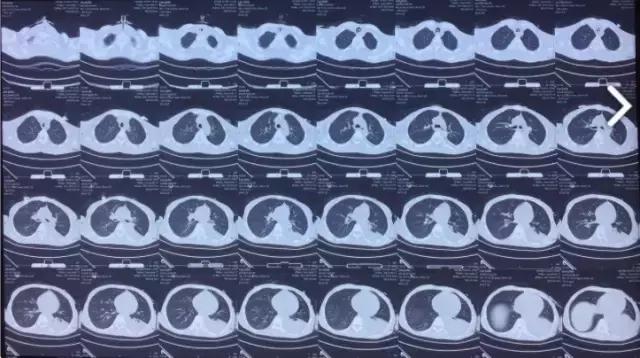 奇迹！跨越600公里疾速异地协作百草枯中毒患者起死回生