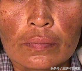 褐斑的原因和治疗方法,褐斑最佳治疗方法