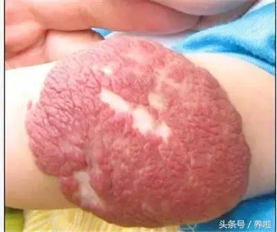 宝妈手部血管瘤,宝宝血管瘤一般多大会消退宝妈们