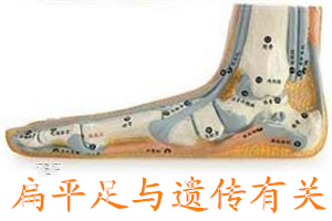 扁平足会诱发足底筋膜炎吗,儿童泡热水诱发扁平足