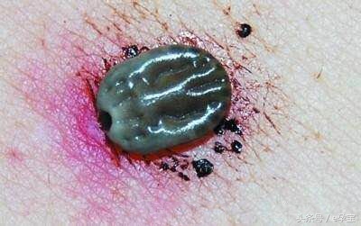 2岁女童反复高烧查不出原因,2岁娃高烧不退