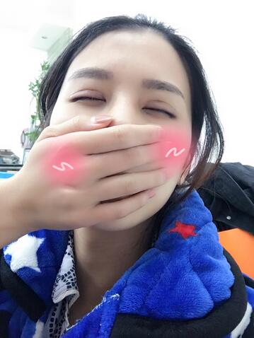 割双眼皮一个月效果,40岁割双眼皮效果好不