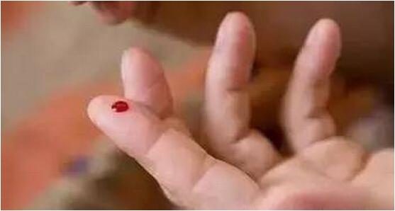 激素脸可以放血治疗吗,面瘫治疗时放血有帮助吗