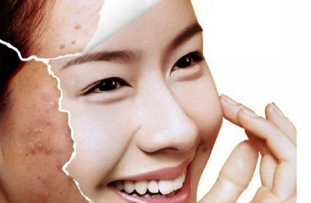 遮瑕祛痘,如何遮瑕祛痘
