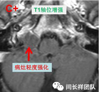 舌头突然不利索,舌头突然间不好使一会就好了