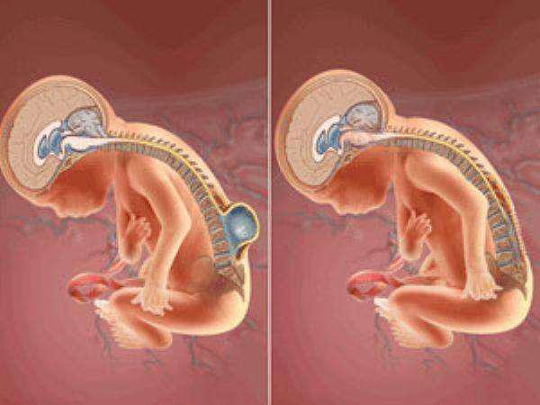 中国有多少先天性脊柱裂病人,脊柱裂属于脊髓病变吗