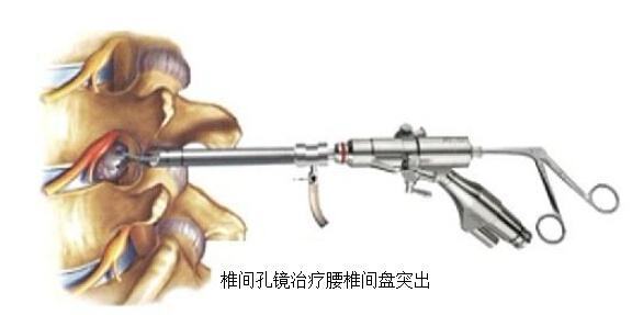 李冰冰腰间盘突出,秦海璐腰间盘突出视频