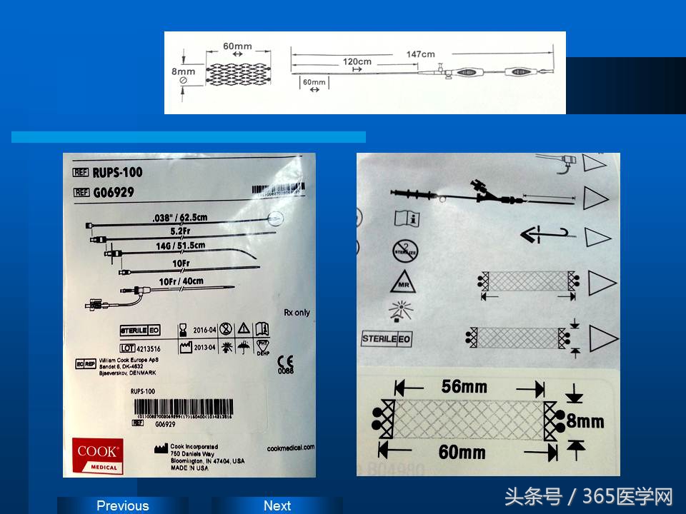 崔进国：消化道出血的介入治疗