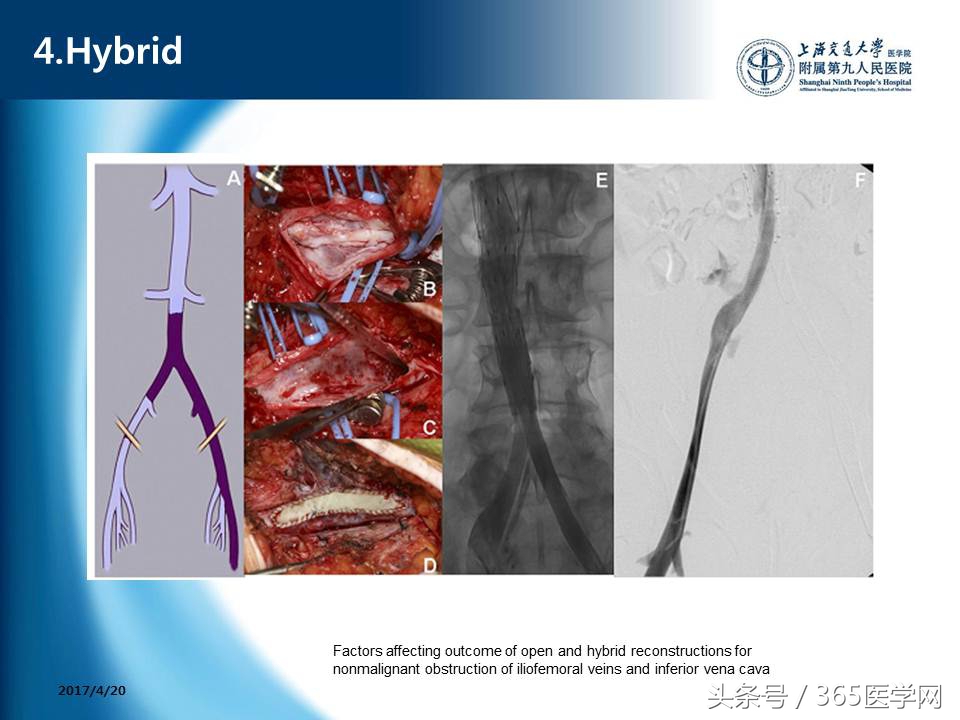 下肢静脉血栓植入滤器后的护理,下肢静脉血栓滤器植入后注意事项