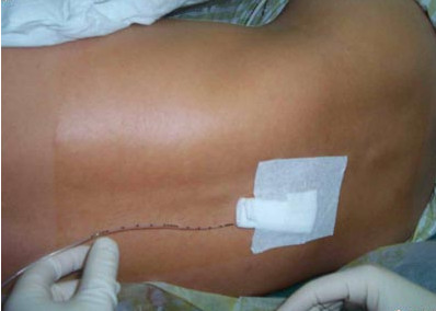 剖腹产麻药针,剖腹产脊椎打麻药的地方有个疙瘩