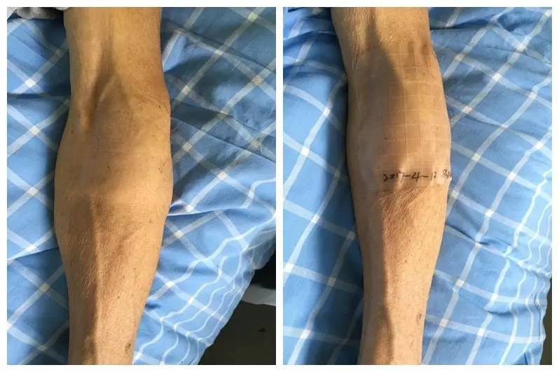 造影剂外渗用什么敷料,造影剂外渗后怎么处理