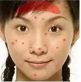 为什么长闭口粉刺痘痘还总是反复,痘痘反复长你知道是为什么吗