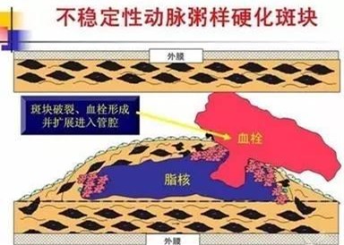 左侧股总动脉粥样斑块形成,吸烟造成动脉粥样斑块形成