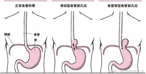 胃病久治不愈是脾虚吗,胃病食管裂孔疝想做手术