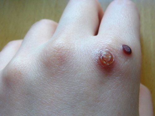 瘊子真的有公母之分吗,牛身上瘊子怎么分公母