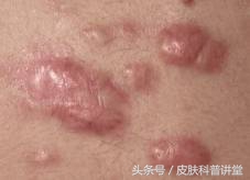 痘印痘痕怎么治,痘印和痘疤怎么治疗最好