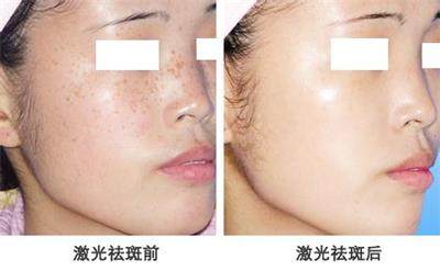 激光祛斑前你需要了解这些才能更好祛斑