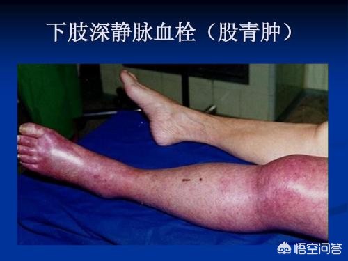 骨折手术后是麻木好还是疼好,骨折术后静脉血栓症状表现